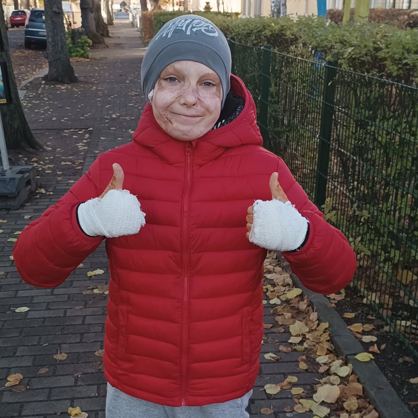 Маска останется воспоминанием. Мальчик, который чудом выжил после ракетного удара в Виннице, снова танцует